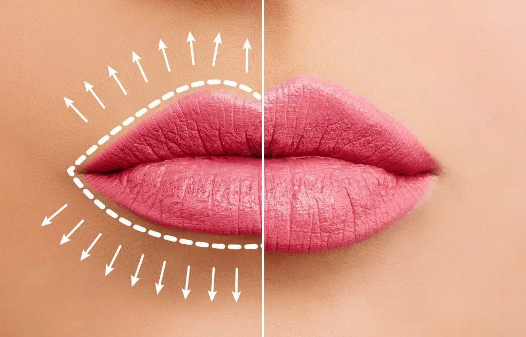 Perfect Beauty with Lip Filler