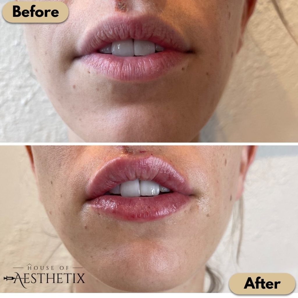 Lip Fillers Before and After images | House of Aesthetix | San Diego CA
