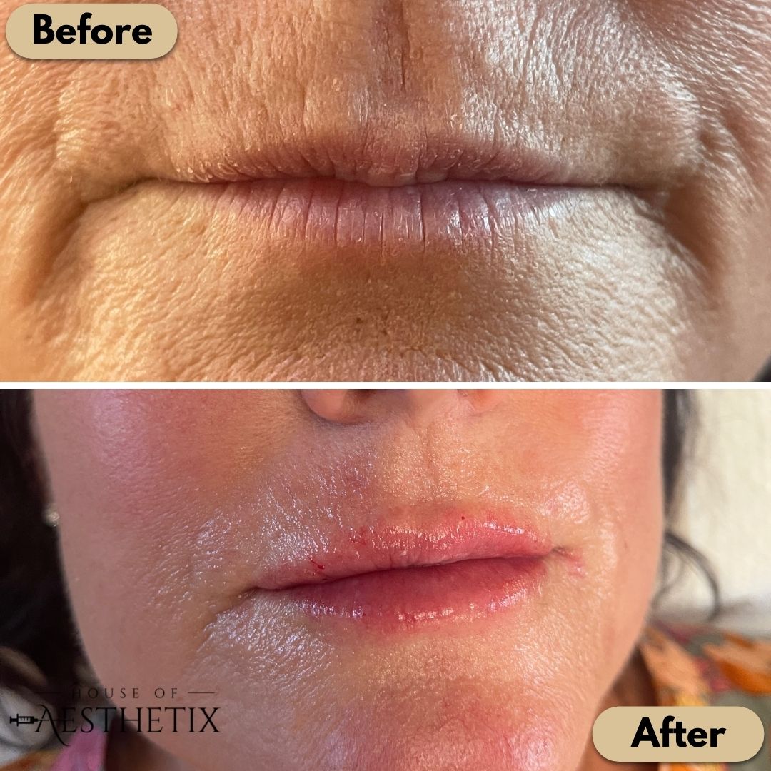 Lip Fillers Before and After images | House of Aesthetix | San Diego CA