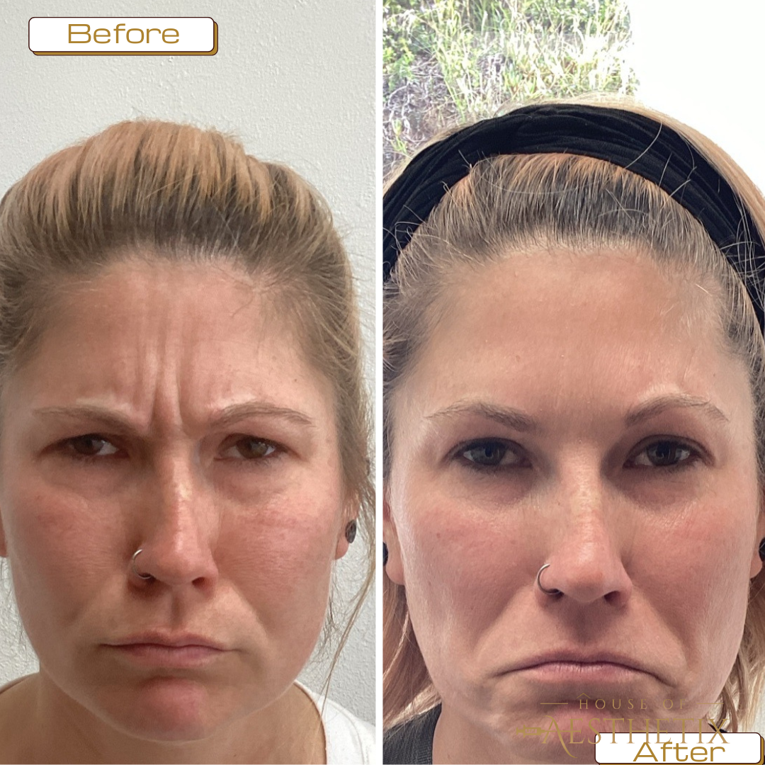 woman before and after dysport injections