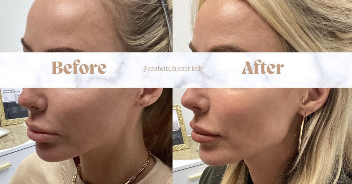 Dermal Fillers in San Diego CA