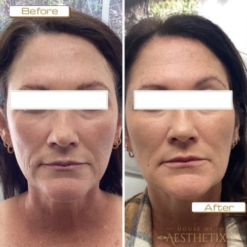 Sculptra before and after