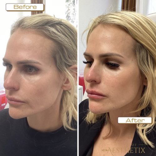 Sculptra before and after