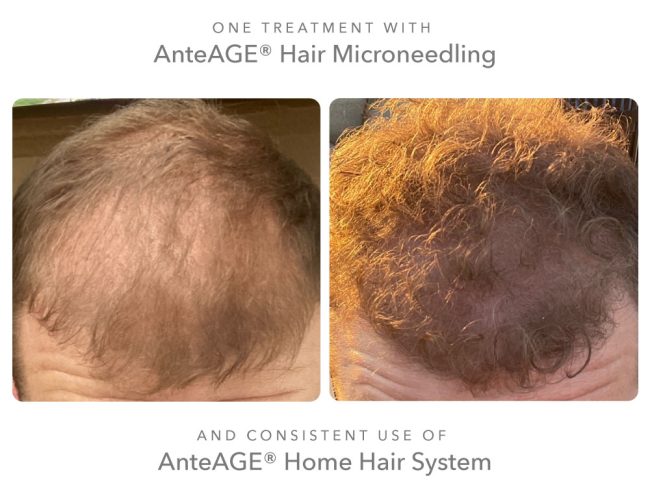 microneedling in san diego ca - hair restoration