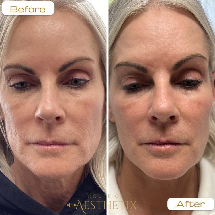 microneedling san diego - before and after